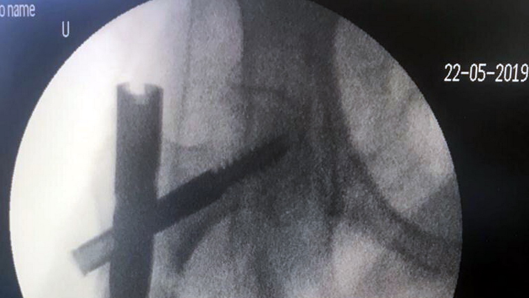 Ступинские врачи поставили на ноги 100-летнюю пациентку с переломом бедра