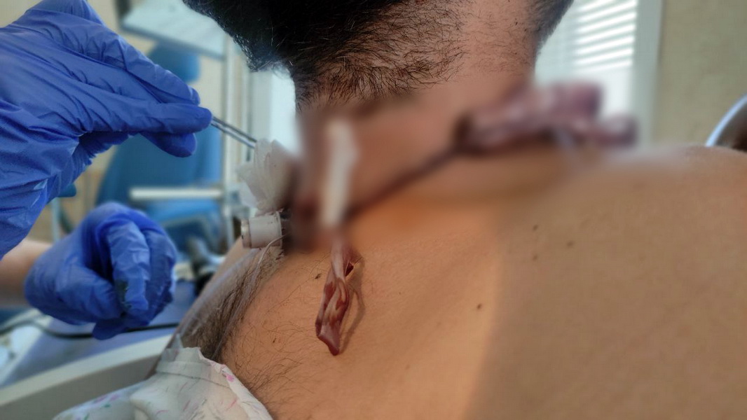 Ступинские врачи спасли мужчину насквозь проткнувшего шею электрической пилой 